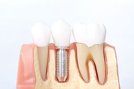 Implantes Dentales